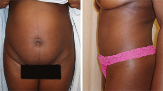 Dr. Rose Abdominal Liposuction 