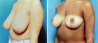 Dr. Rose Breast Reduction 